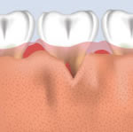 Bone Grafting