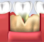 Bone Grafting