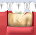 Bone Grafting